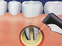 využití laseru v zubní chirurgii
