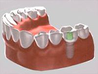 náhrada jednoho zubu implantátem